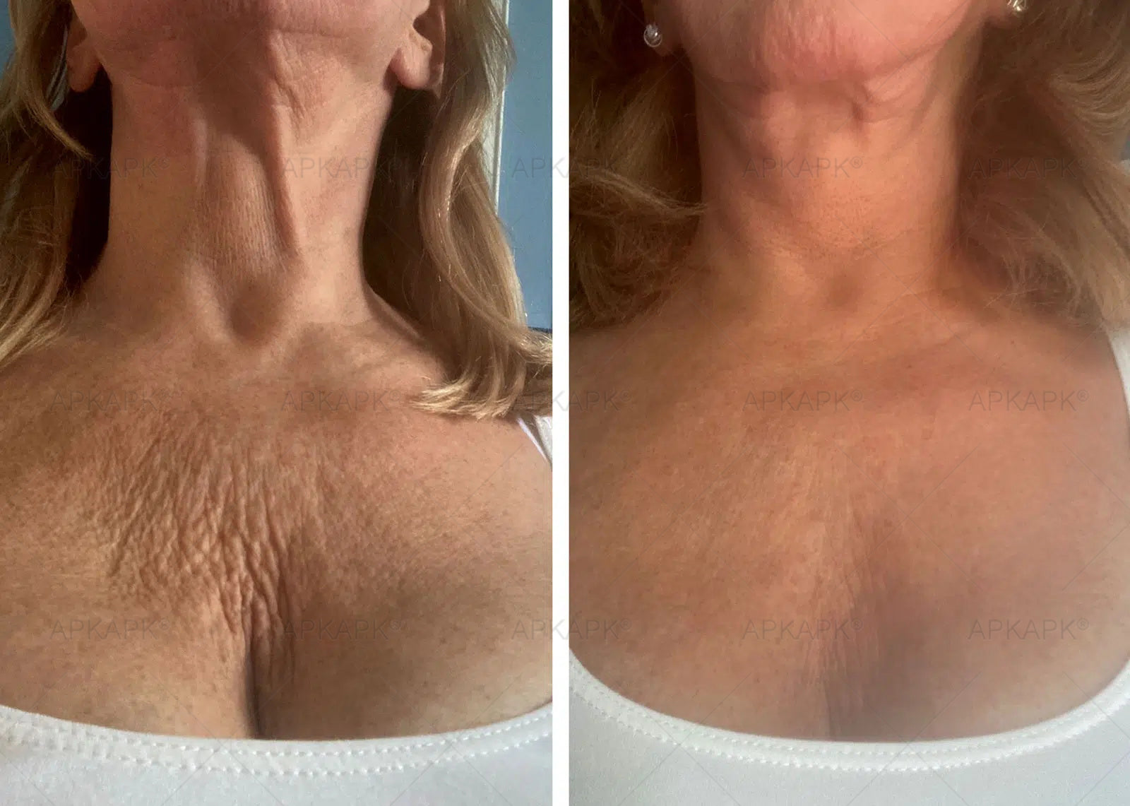 Mulher Aplicando BEENOM